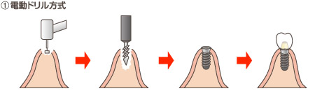 インプラント術式（電動ドリル方式）