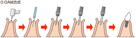 インプラント術式(OAM方式)