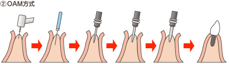 インプラント術式（OAM方式）